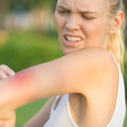 Co pomáhá na svědění pokožky a štípance od hmyzu