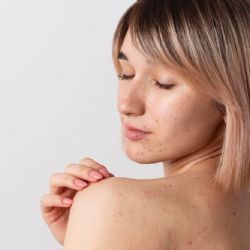 Jak správně pečovat o aknózní pleť?