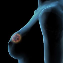 Karlovy Vary: Nemocnice má novou sondu pro nalezení sentinelové uzliny u pacientek s nádorem