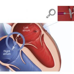 Kardiologové KKN zavedli do svého portfolia novou metodu 