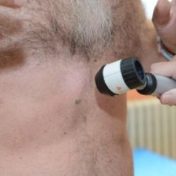 Sokolov: V nemocnici opět upozorní na zhoubný melanom kůže